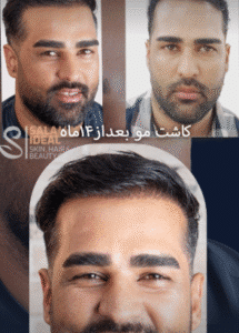 کاشت مو کلینیک سلامت ایده آل