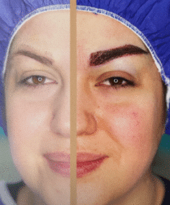 کاشت ابرو کلینیک سلامت ایده آل