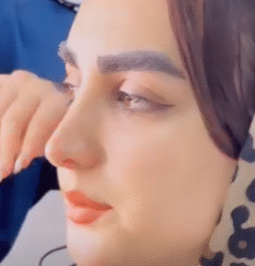 کاشت ابرو کلینیک سلامت ایده آل