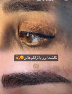 کاشت ابرو کلینیک سلامت ایده آل