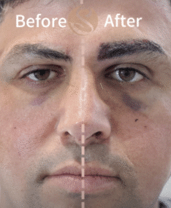 کاشت ابرو کلینیک سلامت ایده آل