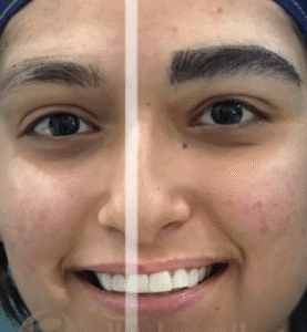 کاشت ابرو کلینیک سلامت ایده آل