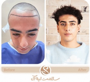 نمونه کاشت مو کلینیک سلامت ایده آل