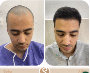 نمونه کاشت مو کلینیک سلامت ایده آل