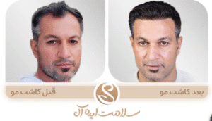 نمونه کاشت مو کلینیک سلامت ایده آل