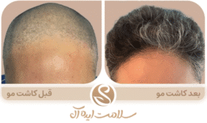 نمونه کاشت مو کلینیک سلامت ایده آل