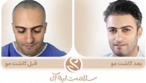 نمونه کاشت مو کلینیک سلامت ایده آل