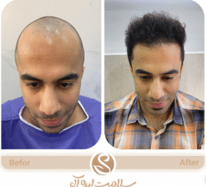 نمونه کاشت مو کلینیک سلامت ایده آل