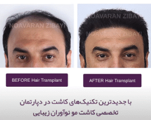 نمونه کاشت مو کلینیک نوآوران زیبایی