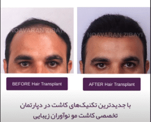 نمونه کاشت مو کلینیک نوآوران زیبایی