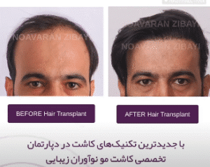 نمونه کاشت مو کلینیک نوآوران زیبایی