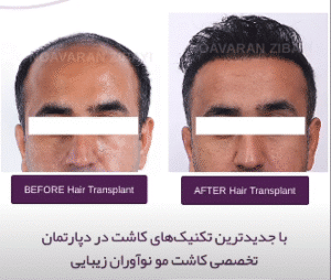 نمونه کاشت مو کلینیک نوآوران زیبایی