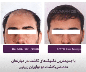 نمونه کاشت مو کلینیک نوآوران زیبایی