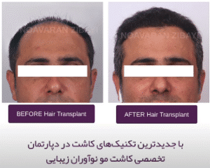 نمونه کاشت مو کلینیک نوآوران زیبایی