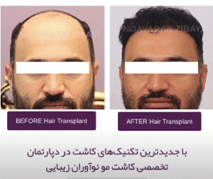 نمونه کاشت مو کلینیک نوآوران زیبایی