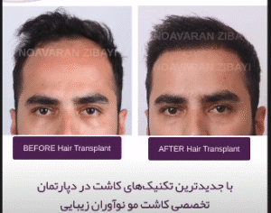 نمونه کاشت مو کلینیک نوآوران زیبایی