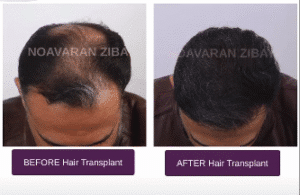 نمونه کاشت مو کلینیک نوآوران زیبایی