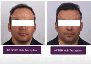 نمونه کاشت مو کلینیک نوآوران زیبایی