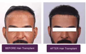 نمونه کاشت مو کلینیک نوآوران زیبایی