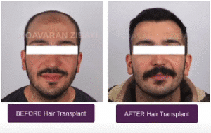 نمونه کاشت مو کلینیک نوآوران زیبایی