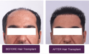 نمونه کاشت مو کلینیک نوآوران زیبایی