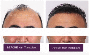 نمونه کاشت مو کلینیک نوآوران زیبایی