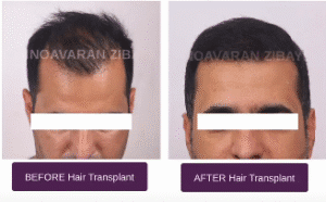 نمونه کاشت مو کلینیک نوآوران زیبایی