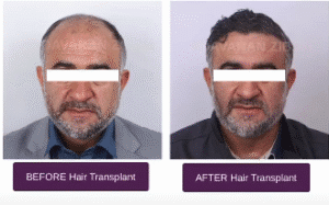 نمونه کاشت مو کلینیک نوآوران زیبایی