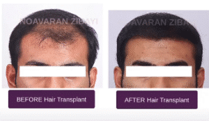 نمونه کاشت مو کلینیک نوآوران زیبایی