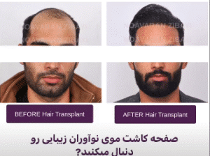 نمونه کاشت مو کلینیک نوآوران زیبایی