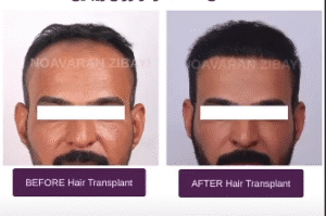 نمونه کاشت مو کلینیک نوآوران زیبایی