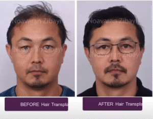 نمونه کاشت مو کلینیک نوآوران زیبایی