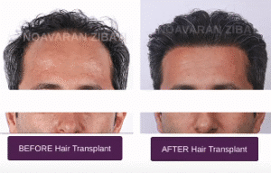 نمونه کاشت مو کلینیک نوآوران زیبایی