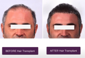 نمونه کاشت مو کلینیک نوآوران زیبایی