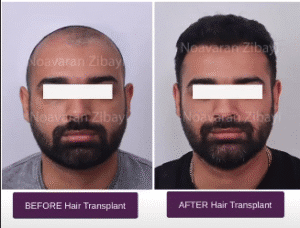 نمونه کاشت مو کلینیک نوآوران زیبایی