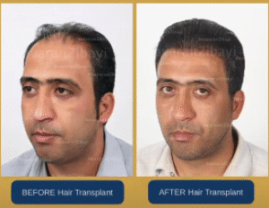 نمونه کاشت مو کلینیک نوآوران زیبایی