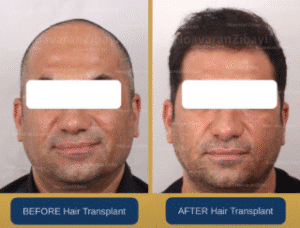 نمونه کاشت مو کلینیک نوآوران زیبایی