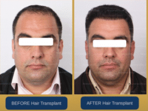 نمونه کاشت مو کلینیک نوآوران زیبایی