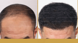 نمونه کاشت مو کلینیک نوآوران زیبایی