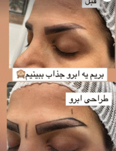 نمونه کاشت ابرو کلینیک زیبایی آبنوس