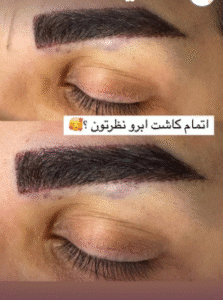 نمونه کاشت ابرو کلینیک زیبایی آبنوس