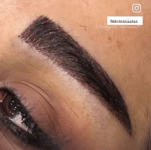 نمونه کاشت ابرو کلینیک زیبایی آبنوس