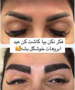 نمونه کاشت ابرو کلینیک زیبایی آبنوس