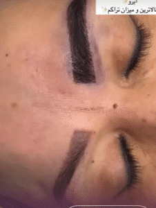 نمونه کاشت ابرو کلینیک زیبایی آبنوس