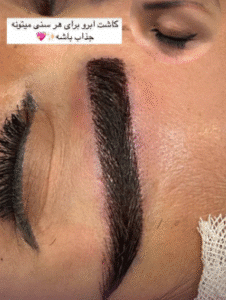 نمونه کاشت ابرو کلینیک زیبایی آبنوس