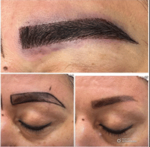 نمونه کاشت ابرو کلینیک زیبایی آبنوس