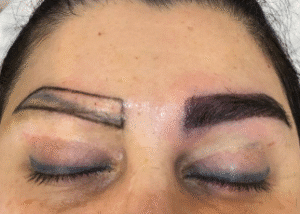 نمونه کاشت ابرو کلینیک زیبایی آبنوس