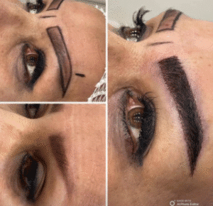 نمونه کاشت ابرو کلینیک زیبایی آبنوس