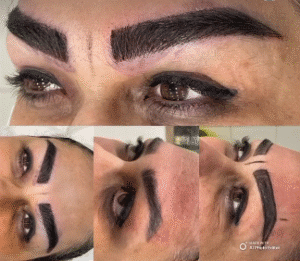 نمونه کاشت ابرو کلینیک زیبایی آبنوس