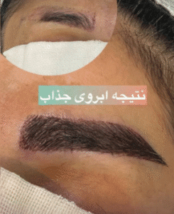 نمونه کاشت ابرو کلینیک زیبایی آبنوس